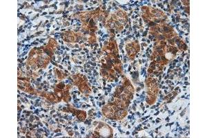 Immunohistochemical staining of paraffin-embedded Carcinoma of liver tissue using anti-SIL1 mouse monoclonal antibody. (SIL1 抗体)