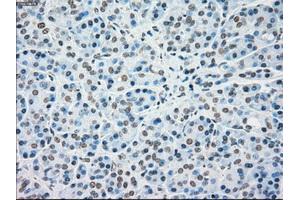 Immunohistochemical staining of paraffin-embedded Carcinoma of kidney tissue using anti-MAP2K4mouse monoclonal antibody. (MAP2K4 抗体)