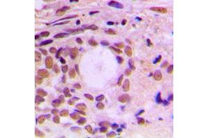 Immunohistochemical analysis of Cyclin F staining in human breast cancer formalin fixed paraffin embedded tissue section. (Cyclin F 抗体  (C-Term))