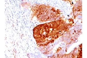 Formalin-fixed, paraffin-embedded human Colon Carcinoma stained with ALDH1A1 Mouse Monoclonal Antibody (ALDH1A1/1381). (ALDH1A1 抗体  (AA 315-434))