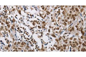 Immunohistochemistry of paraffin-embedded Human esophagus cancer tissue using CMTM2 Polyclonal Antibody at dilution 1:60 (CMTM2 抗体)