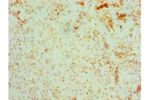 Immunohistochemistry of paraffin-embedded human ovarian cancer using ABIN7158679 at dilution of 1:100 (BRCC3 抗体  (AA 14-316))