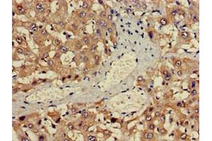 Immunohistochemistry of paraffin-embedded human liver cancer using ABIN7142600 at dilution of 1:100 (ALAS1 抗体  (AA 57-285))