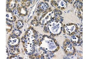 ABIN7096922 and ABIN7100988 at 1/100 staining human ovarian cancer by IHC-P.