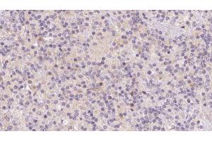 ABIN6273120 at 1/100 staining Human lymph cancer tissue by IHC-P. (HBXIP 抗体  (Internal Region))