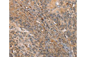 Immunohistochemistry of Human ovarian cancer using HK3 Polyclonal Antibody at dilution of 1:40 (HK3 抗体)