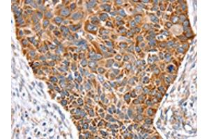 The image on the left is immunohistochemistry of paraffin-embedded Human esophagus cancer tissue using ABIN7131122(SNX11 Antibody) at dilution 1/30, on the right is treated with fusion protein. (SNX11 抗体)