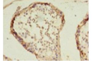 Immunohistochemistry of paraffin-embedded human colon cancer using ABIN7155301 at dilution of 1: 100 (HDAC1 抗体  (AA 1-482))