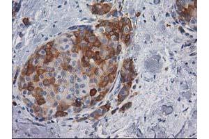 Immunohistochemical staining of paraffin-embedded Adenocarcinoma of Human breast tissue using anti-AK5 mouse monoclonal antibody. (Adenylate Kinase 5 抗体)