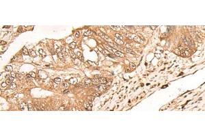 Immunohistochemistry of paraffin-embedded Human colorectal cancer tissue using MAGEA1 Polyclonal Antibody at dilution of 1:65(x200) (MAGEA1 抗体)