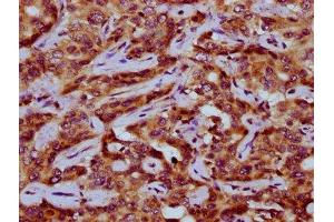IHC image of ABIN7162965 diluted at 1:200 and staining in paraffin-embedded human liver cancer performed on a Leica BondTM system. (PEX11A 抗体  (AA 106-219))