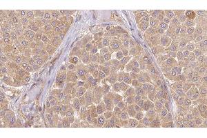 ABIN6273647 at 1/100 staining Human Melanoma tissue by IHC-P. (IGFL1 抗体)