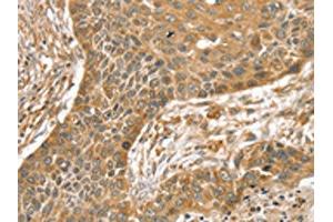 The image on the left is immunohistochemistry of paraffin-embedded Human esophagus cancer tissue using ABIN7192541(SLIT1 Antibody) at dilution 1/35, on the right is treated with synthetic peptide. (SLIT1 抗体)