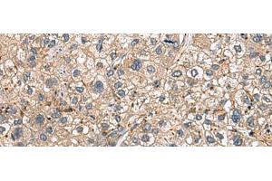 Immunohistochemistry of paraffin-embedded Human liver cancer tissue using HLA-DRA Polyclonal Antibody at dilution of 1:30(x200) (HLA-DRA 抗体)