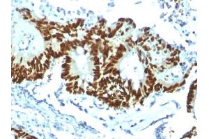 Formalin-fixed, paraffin-embedded human Colon Carcinoma stained with p53 Recombinant Rabbit Monoclonal Antibody (TP53/1799R). (Recombinant p53 抗体)