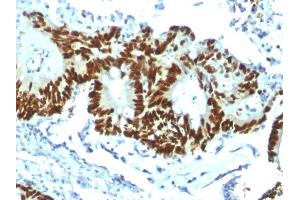 Formalin-fixed, paraffin-embedded human Colon Carcinoma stained with p53 Recombinant Rabbit Monoclonal Antibody (TP53/1799R).