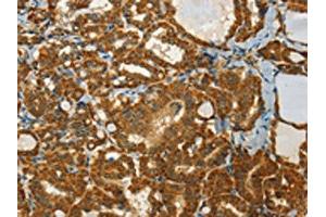The image on the left is immunohistochemistry of paraffin-embedded Human thyroid cancer tissue using ABIN7191682(NPAP1 Antibody) at dilution 1/60, on the right is treated with synthetic peptide. (NPAP1 抗体)