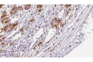 ABIN6272308 at 1/100 staining Human liver cancer tissue by IHC-P. (FFAR3 抗体  (C-Term))