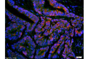 Formalin-fixed and paraffin-embedded human colon carcinoma labeled with Anti-ompF(putative outer membrane porin F protein) Polyclonal Antibody, Unconjugated (ABIN677363) 1:200, overnight at 4°C, The secondary antibody was Goat Anti-Rabbit IgG, Cy3 conjugated used at 1:200 dilution for 40 minutes at 37°C. (Ompf (AA 171-213) 抗体)