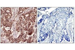 Immunohistochemical analysis of paraffin-embedded human breast carcinoma tissue using NFkB-p105(Phospho-Ser927) Antibody(left) or the same antibody preincubated with blocking peptide(right).