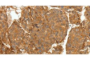 Immunohistochemistry of paraffin-embedded Human lung cancer tissue using COL4A1 Polyclonal Antibody at dilution 1:30 (COL4A1 抗体)