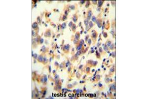 UGT3A2 antibody immunohistochemistry analysis in formalin fixed and paraffin embedded human testis carcinoma followed by peroxidase conjugation of the secondary antibody and DAB staining. (UGT3A2 抗体  (C-Term))