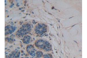 DAB staining on IHC-P; Samples: Human Breast cancer Tissue (Thrombospondin 1 抗体  (AA 24-221))