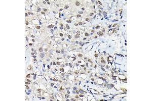 Immunohistochemistry (IHC) image for anti-6-phosphofructo-2-Kinase/fructose-2,6-Biphosphatase 3 (PFKFB3) (AA 400-500) antibody (ABIN6145485)