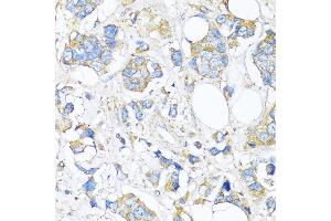 Immunohistochemistry of paraffin-embedded Human breast cancer using TIMP2 antibody (ABIN7268483) at dilution of 1:150 (40x lens). (TIMP2 抗体  (AA 100-200))
