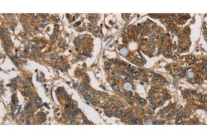 Immunohistochemistry of paraffin-embedded Human colon cancer tissue using UBE2S Polyclonal Antibody at dilution 1:40 (UBE2S 抗体)