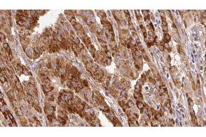 ABIN6267121 at 1/100 staining Human thyroid cancer tissue by IHC-P. (GRB10 抗体  (pSer476))