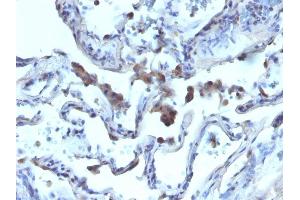 Formalin-fixed, paraffin-embedded human Lung Carcinoma stained with AMACR / p504S Rabbit Polyclonal Antibody. (AMACR 抗体)