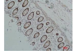 Immunohistochemistry (IHC) analysis of paraffin-embedded Human Colon Carcicnoma using HSP90 alpha Mouse Monoclonal Antibody diluted at 1:200. (HSP90AA2 抗体)