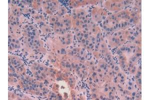 DAB staining on IHC-P; Samples: Human Liver cancer Tissue (KRT8 抗体  (AA 92-393))