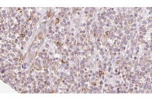 ABIN6273209 at 1/100 staining Human lymph cancer tissue by IHC-P. (SH3KBP1 抗体  (N-Term))