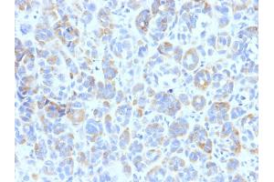 Formalin-fixed, paraffin-embedded human Melanoma stained with TYRP1 Mouse Monoclonal Antibody (TYRP1/807) (Tyrosinase-Related Protein 1 抗体)