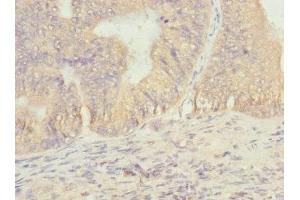 Immunohistochemistry of paraffin-embedded human prostate cancer using ABIN7172901 at dilution of 1:100 (EIF2B1 抗体  (AA 1-305))