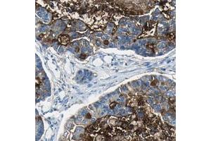 Immunohistochemical staining of human lung cancer, adenocarcinoma shows moderate cytoplasmic positivity in tumor cells.