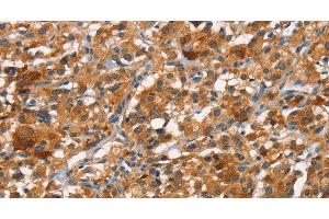 Immunohistochemistry of paraffin-embedded Human thyroid cancer tissue using CDC25B Polyclonal Antibody at dilution 1:45 (CDC25B 抗体)
