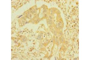 Immunohistochemistry of paraffin-embedded human pancreatic cancer using ABIN7156691 at dilution of 1:100