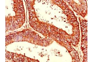 Immunohistochemistry of paraffin-embedded human endometrial cancer using ABIN7174480 at dilution of 1:100 (CDC34 抗体  (AA 1-236))