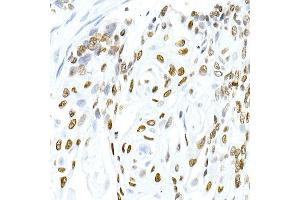 Immunohistochemistry of paraffin-embedded human esophageal cancer using Phospho-Histone H3. (Histone H3.3 抗体  (pSer31))