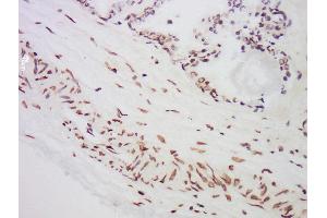 Formalin-fixed and paraffin embedded human prostate labeled with Anti-MST1 Polyclonal Antibody, Unconjugated  at 1:300 followed by conjugation to the secondary antibody and DAB staining. (MST1 抗体  (AA 385-487))