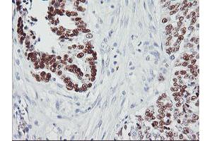 Immunohistochemical staining of paraffin-embedded Adenocarcinoma of Human ovary tissue using anti-TP53 mouse monoclonal antibody. (p53 抗体)