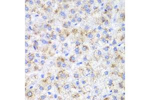 Immunohistochemistry of paraffin-embedded human liver cancer using HAO1 antibody at dilution of 1:200 (400x lens).