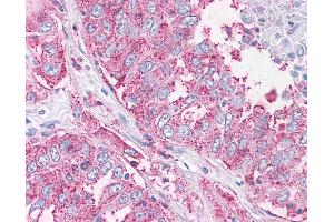 Anti-NEK6 antibody IHC of human Lung, Non-Small Cell Carcinoma. (NEK6 抗体  (N-Term))