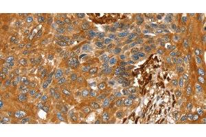 Immunohistochemistry of paraffin-embedded Human esophagus cancer tissue using TAGLN Polyclonal Antibody at dilution 1:30 (Transgelin 抗体)
