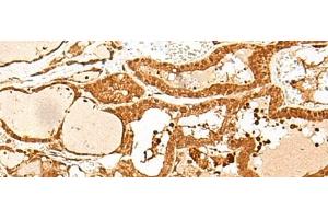 Immunohistochemistry of paraffin-embedded Human thyroid cancer tissue using GTF3C3 Polyclonal Antibody at dilution of 1:30(x200) (GTF3C3 抗体)