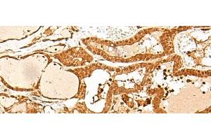 Immunohistochemistry of paraffin-embedded Human thyroid cancer tissue using GTF3C3 Polyclonal Antibody at dilution of 1:30(x200)