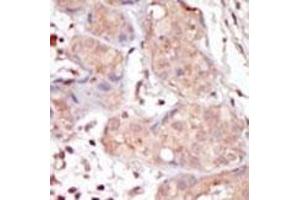 Formalin-fixed and paraffin-embedded human cancer tissue reacted with the primary antibody, which was peroxidase-conjugated to the secondary antibody, followed by DAB staining. (MAK 抗体  (C-Term))